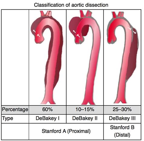 diseccion aortica